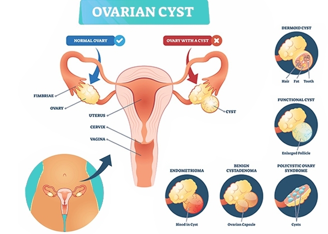 ovarian cysts treatment