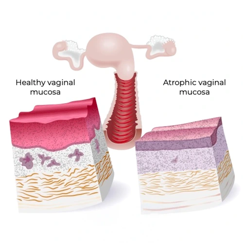 DRN-Estrogen-Therapy DRN estrogen therapy